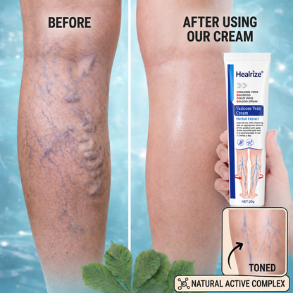 Healrize®Varicose Vein & Circulation Cream – Lighter Legs and Visibly Improved Appearance