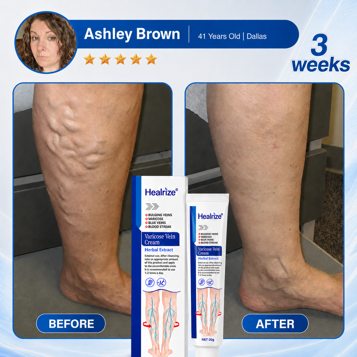 Healrize®Varicose Vein & Circulation Cream – Lighter Legs and Visibly Improved Appearance