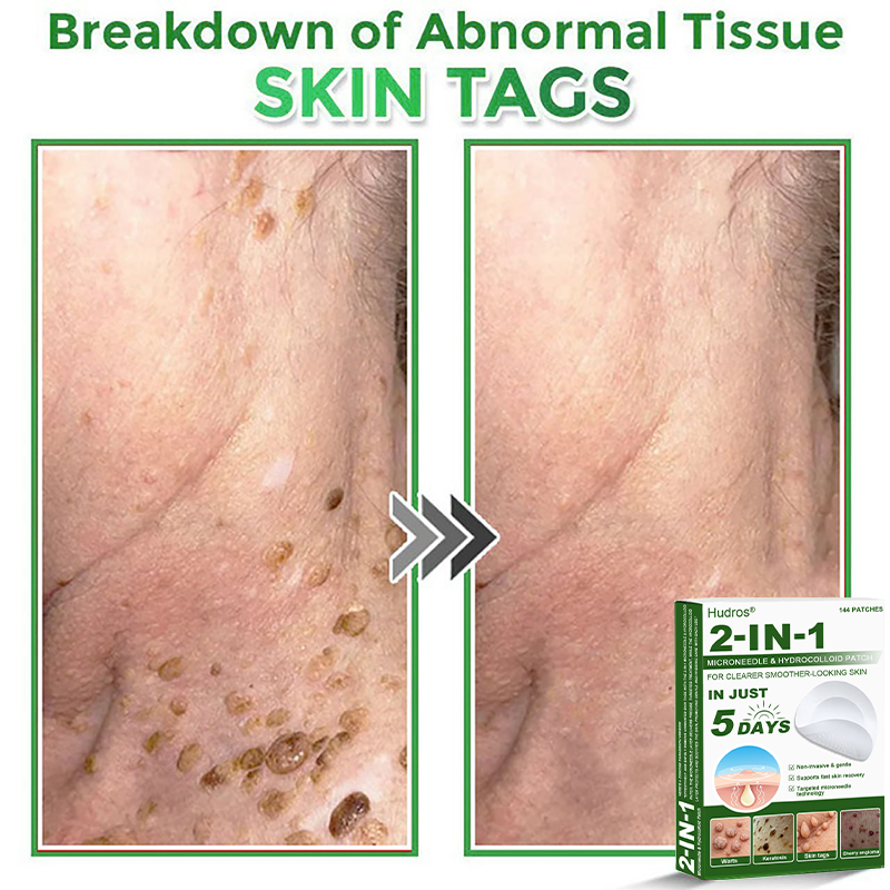 📌Hudros® 2-in-1 Microneedle & Hydrocolloid Patch | Raised Moles,Acne,  Flat Warts & Skin Tags Remover | Improves Wrinkles, Scars & Blemishes | Invisible Star Pimple Patches for Face & Body | 144 Count