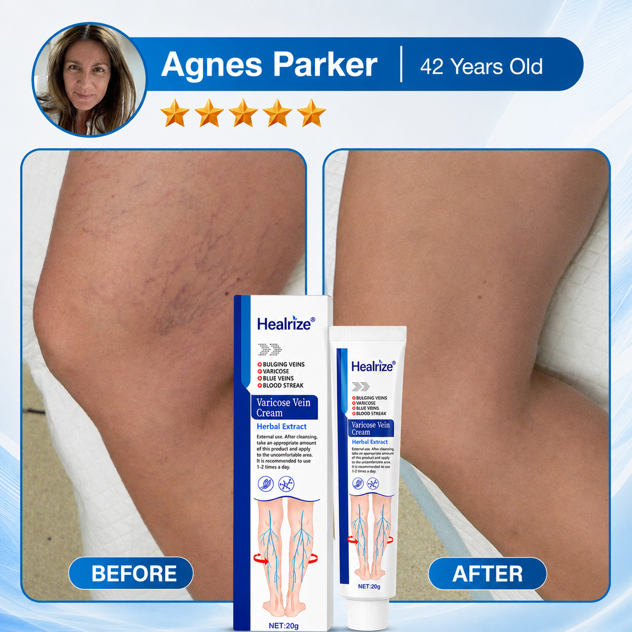 Healrize®Varicose Vein & Circulation Cream – Lighter Legs and Visibly Improved Appearance